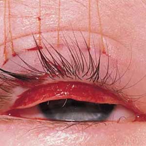 Abnormal lash correction in vijayawada