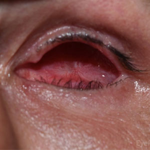 Enucleation, Evisceration & Exenteration in Vijayawada