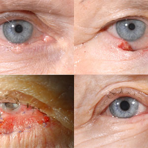 Eyelid reconstruction surgeon in Vijayawada